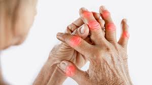 gout chronic disease