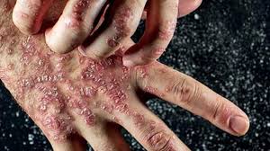 autoimmune disease chronic disease