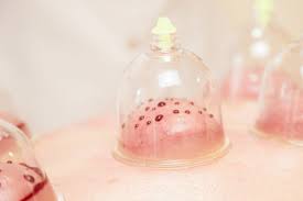 best hijama and homeopathic services