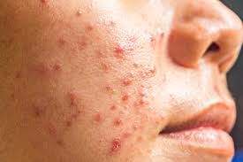 Hijama Therapy for Acne