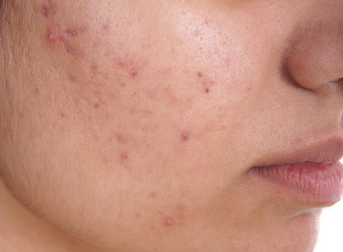 Hijama Therapy for Acne — A Natural Way to Clear Your Skin